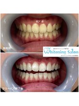 ホワイトニングサロン 名古屋駅店/【ホワイトニング施術例】