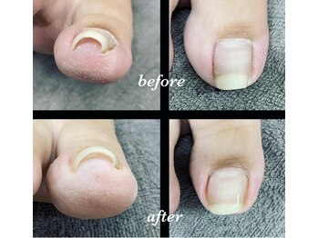 nail salon Liaの写真/巻き爪をケアしながら美爪へ。見た目も美しく整えるから、人前でも堂々と出せる綺麗な足元に