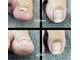 nail salon Liaの写真/巻き爪をケアしながら美爪へ。見た目も美しく整えるから、人前でも堂々と出せる綺麗な足元に