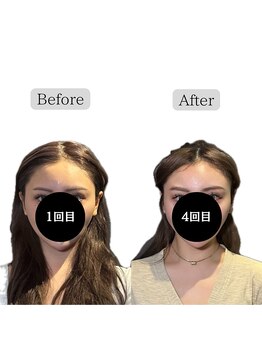 クリアランス(CLEARANCE)/施術回数4回 担当者TAIGA