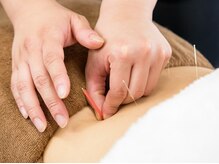 南行駅近整骨院/鍼を打っている様子