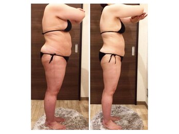 エステサロン ベリシモ(Bellissimo)/痩身/ビフォーアフター