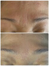 マリエンドリー/眉間のシワ改善　　