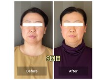 歪みも整い、フェイスラインすっきり♪