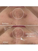 ミエル 神戸店(Miel)/毛穴洗浄で黒ずみ改善