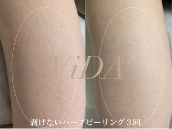 ヴィーダ 渋谷松濤(ViDA)/二の腕のポツポツ毛穴改善