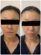 ポマイカイ 名古屋丸の内店(pomaikai)/ハイドロフェイシャル