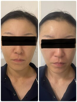 ポマイカイ 名古屋丸の内店(pomaikai)/ハイドロフェイシャル