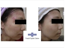 フェイシャルスタイリストサロン 四谷店/ケア例（72）