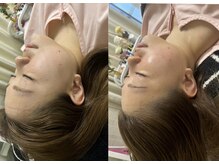 マホロバ(mahoroba)/美容鍼×ハーブピーリング