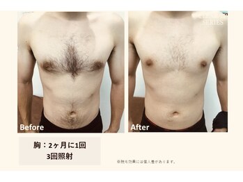 サロン ルアナ(salon luana)/濃い胸毛にお困りの方☆