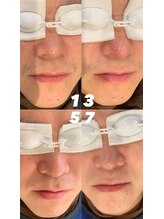 ゴールデンエイジ(Golden Age)/【ヒゲ脱毛】Before＆After