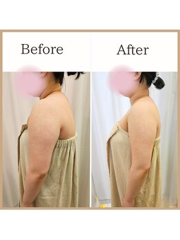 サロンルーチェ(Salon Luce)/ビフォーアフター/施術回数12回