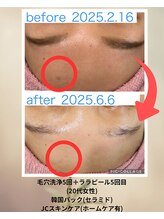 クローバー(clover)/ニキビ後のケアすればシミ予防