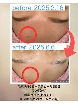 クローバー(clover)/ニキビ後のケアすればシミ予防