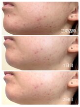 ククル(KUKULU)/陶肌ピール1回の効果（20代女性