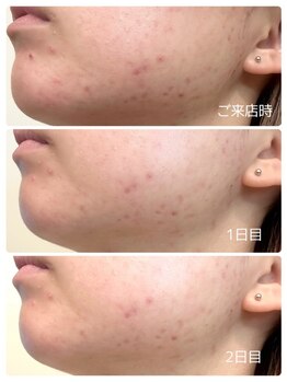 ククル(KUKULU)/陶肌ピール1回の効果(20代女性