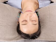 整体 越/美容鍼