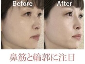 隆鼻矯正専門店 ラプリセレネ (Raplit Selene)/隆鼻+輪郭矯正(小顔)40分10回