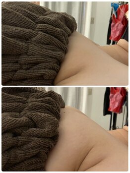 スマイルクルー(SmileClue)/初回ビフォーアフター症例