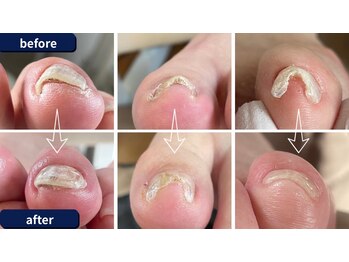 歪みのある爪も諦めない