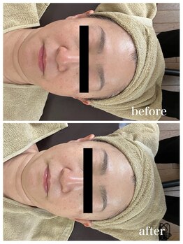 ジャスミン(Jasmin)/臍帯血幹細胞×AC-11×NMN