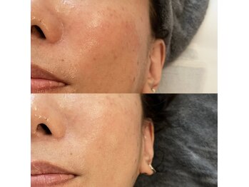 グレアージュ(GLEAGE)/たるみケア エイジングコース!