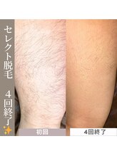 アカラビューティー(Akala Beauty)/セレクト脱毛〈５回終了！〉