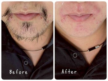 癒し処 ほっこり 海田店/【Wax +光脱毛】20代男性