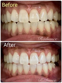 札幌セルフホワイトニング ラディアンス(Radiance)/#札幌ホワイトニング