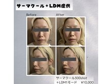 UBメディカルサロン 新宿/LDM＋サーマクール