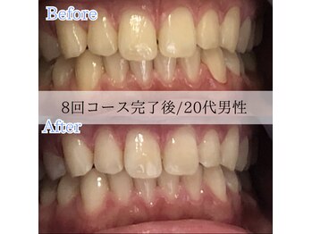 ホワイトニングカフェ 藤が丘店(WhiteningCafe)/8回コース完了後☆