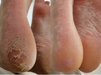 ソムネイル(Som Nail)の写真/【韓国本場の角質ケアが熊本上陸★】韓国で学んだ専門技術×本場ケア用品で足裏をやさしく集中ケア！
