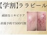 【学割U24】頑固なニキビケア 何度も繰り返す肌荒れララピで解決¥8800