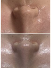 リノ(lino)/毛穴ケア