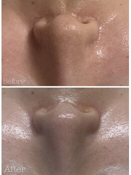 リノ(lino)/毛穴ケア