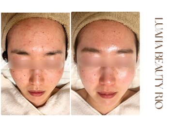 リオ(RIO)/繰り返す肌荒れも◎