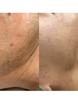メンズサロンエヌエー(MEN'S SALON NA)/【肌荒れ改善】ヒゲ脱毛