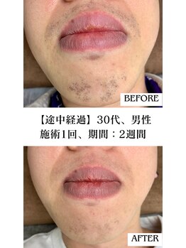 バディーズ(BUDDieS)/クリニック脱毛から乗換のお客様