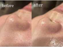 ビビ(Vivi)/毛穴洗浄