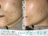 【8月限定】20代に大人気!毛穴のザラつき、ニキビケアはハーブトリートメント