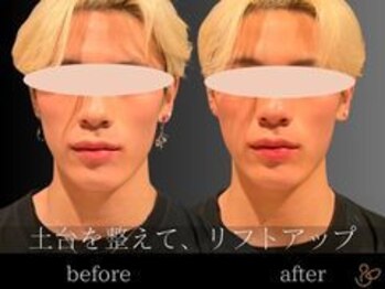 チョコバリ 渋谷店(chocobari)/小顔×リフトアップ(美容鍼)20代