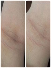 ユニヴェール(univers)/ワキ脱毛