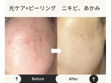 シャムロック/光お顔ケア！ビフォーアフター