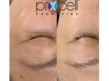 レア(le'a)/目元のシワもプロセルセラピーズ