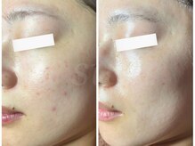 スウ(su:)/頑固なニキビもこの通り！