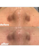 メンズエムボーテ 太田店(Men's M BEAUTE33)/【全顔毛穴洗浄】