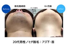 メンズアメリ/高知/メンズ脱毛/ヒゲ/全身/VIO