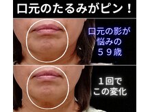 目元 口元のたるみ 眉間シワ改善専門サロン/口元たるみを引き締めたい方向け
