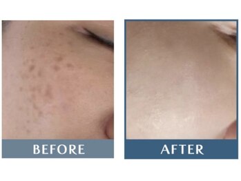 シミケア高松/シミが改善！？【事例紹介】